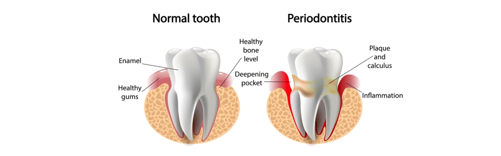 gum disease prevention