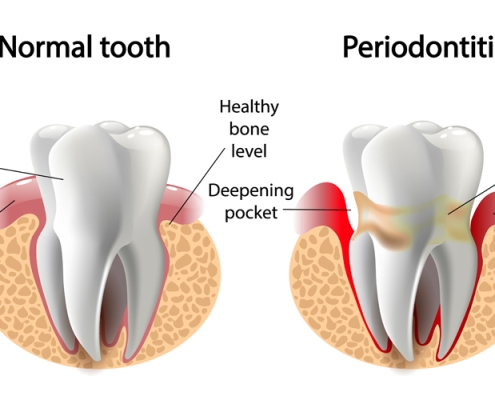 gum disease prevention